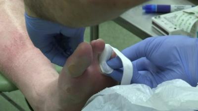 A foot being treated