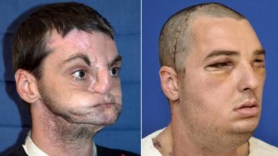 Richard Norris before (L) and after his face transplant