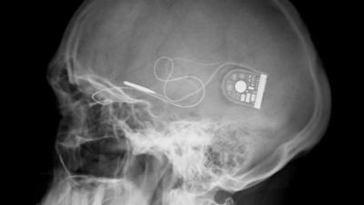 X-ray of skull showing position of implant