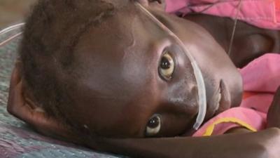 A young Sudanese girl suffering from malnutrition