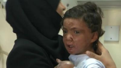 Injured Syrian child