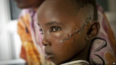 Jamila Yakobo who was slashed by a machete while she was trying to flee with her father from an attack on her village of Kilelengwani