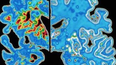 Computer graphic of a vertical (coronal) slice through the brain of an Alzheimer patient (at left) compared with a normal brain (at right).