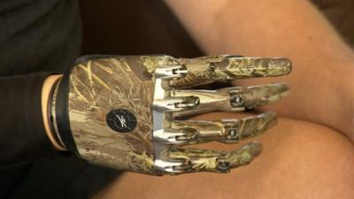 Mike Swainger's bionic hand