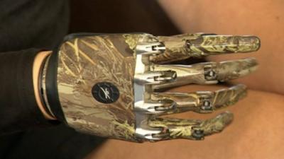 Mike Swainger's bionic hand