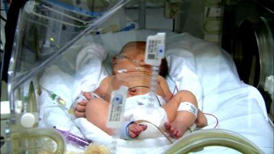 A baby in intensive care