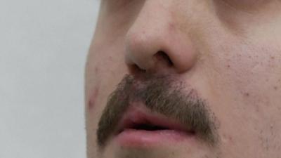 Moustache implant in Istanbul