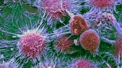 Kidney cancer cells