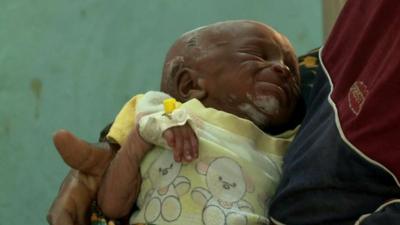 A baby suffering from lead poisoning