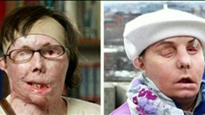 Carmen Blandin Tarleton, before and after the transplant