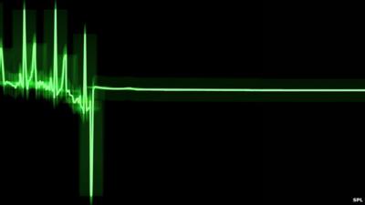 ECG (electrocardiogram) trace