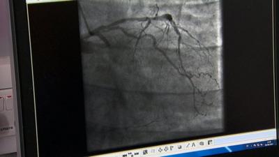 Angiogram