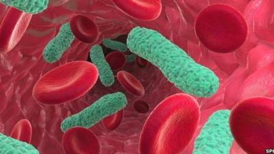 Bacterial infection of the blood causing sepsis