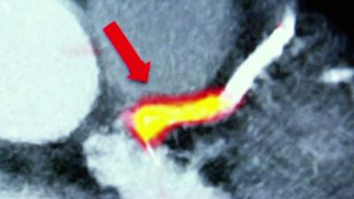 Heart scan showing affected area