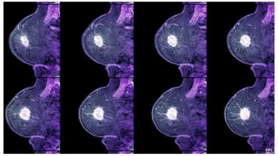 Breast cancer scans