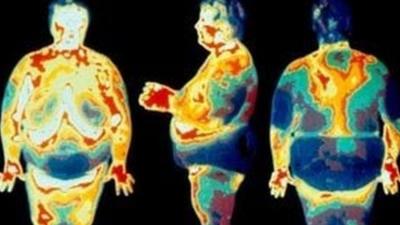 Thermogram of obese people