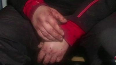 Bloodied hands of Dmytro Bulatov