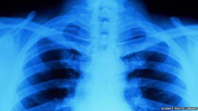 X-ray of a person's chest