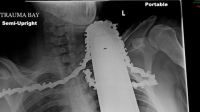 X-ray shows chainsaw embedded in James Valentine's neck