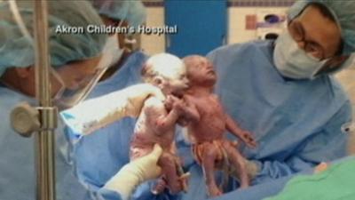 Babies holding hands after birth