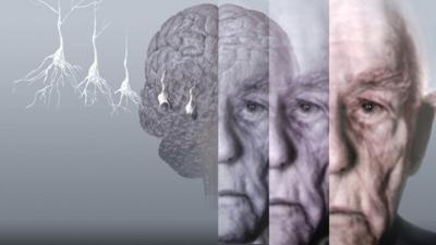 Conceptual computer artwork showing the brain of an elderly man affected by Alzheimers disease.