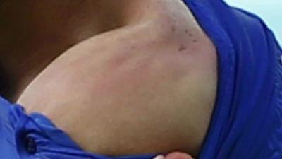 Alleged bite marks