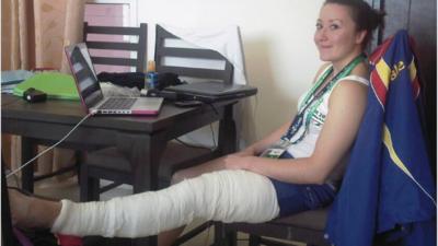 Olivia Curran with her leg in plaster