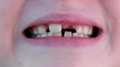 Child's mouth showing teeth