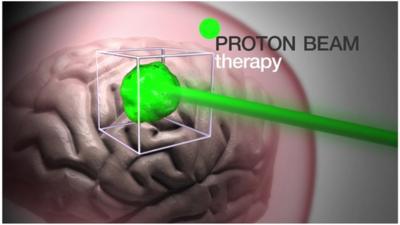 Graphic illustrating how proton beam therapy works