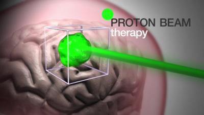 A graphic illustrating proton beam therapy