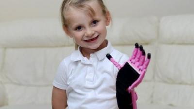 Hayley Fraser, from Inverness has a prosthetic hand made with 3D printing technology.