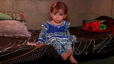 Child with polio, Pakistan