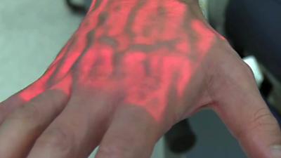 A hand is lit up under vein detecting device