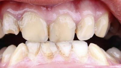 Bad teeth (Pic: Thinkstock)