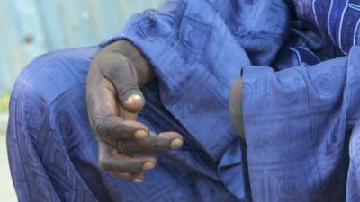 Man whose hand was cut off by Boko Haram