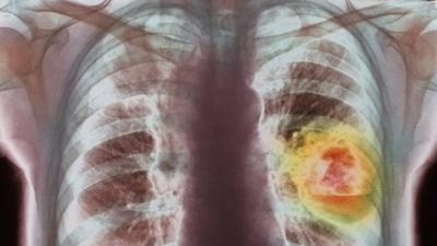 X-ray showing lung cancer