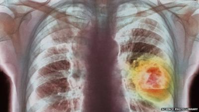 X-ray showing lung cancer