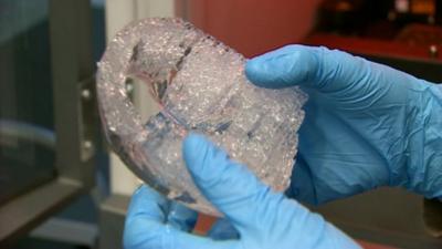 A 3D-printed facial implant