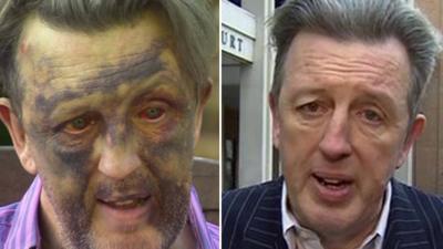 Paul Kohler soon after the attack (left), and today (right)