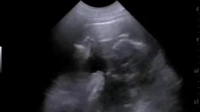 A still from the ultrasound