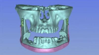 Computer image of jaw