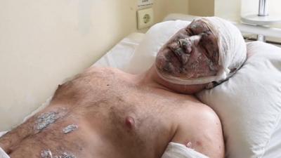 Injured miner from the Zasyadko mine in Ukraine