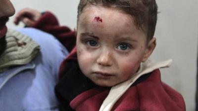 Injured child in Damascus - 25/01/2015