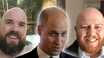 Prince William Welcomed To The Bald Club By Serving