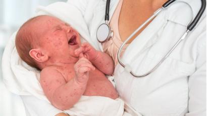 qué hacer para la inflamación después de la vacuna contra la gripe