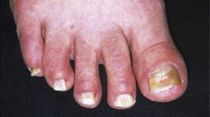 toe fungal infection