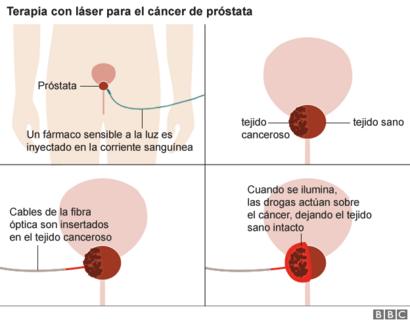 luz verde vs cirugía de próstata con láser turpy