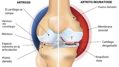 Artrózis - a leggyakoribb ízületi megbetegedés - Dr. Zátrok Zsolt blog