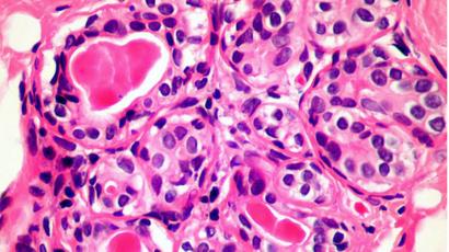 Immune Discovery May Treat All Cancer Bbc News