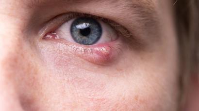 infecciones del ojo sintomas